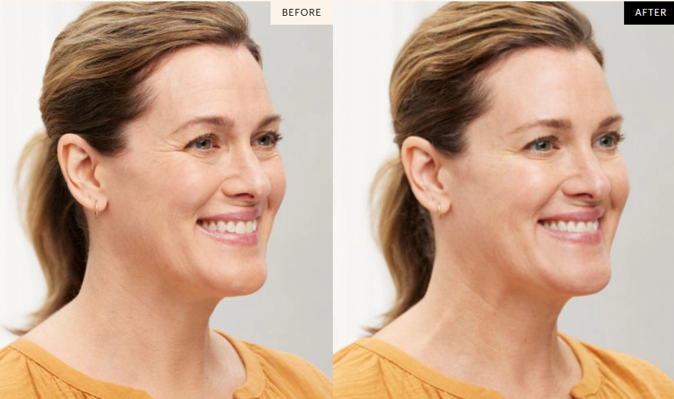 Botox Package 40 Units Get 10 FREE (limit 1)